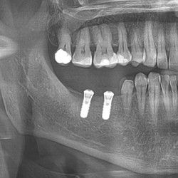 Ugradnja zubnih implantata Banovo brdo