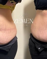 Uklanjanje celulita  Banovo brdo