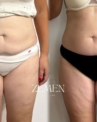 Uklanjanje celulita Cerak