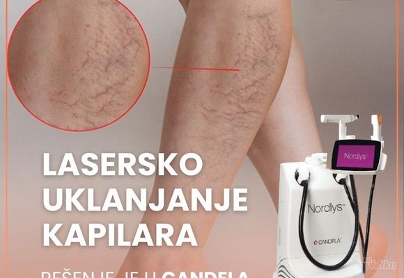 Lasersko uklanjanje kapilara Voždovac