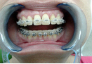 Fiksna zubna proteza Banovo brdo