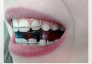 Zubna proteza Banovo brdo