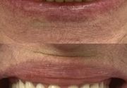 Bezmetalne krunice za zube
