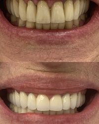 Bezmetalne krunice za zube