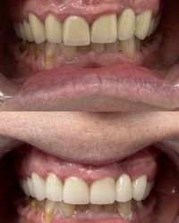 Bezmetalne navlake za zube