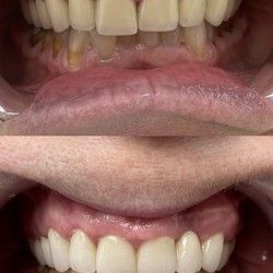 Bezmetalne navlake za zube