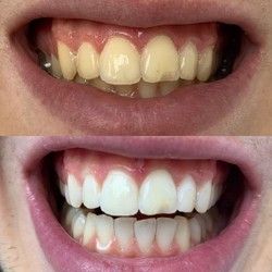 Izbeljivanje zuba Beo White Dent