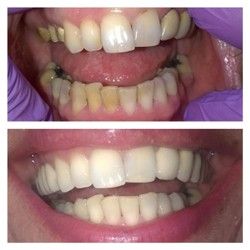 Kombinacija metalokeramičkih krunica i laserskog izbeljivanja zuba