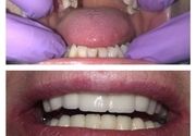 Kombinacija metalokeramičkih mostova na prirodnim zubima i na implantatima