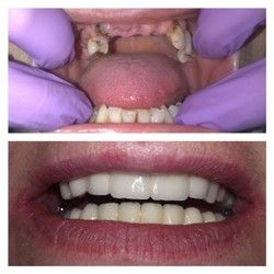 Kombinacija metalokeramičkih mostova na prirodnim zubima i na implantatima