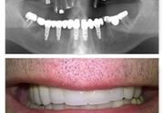 Kombinacija mostova na implantatima i prirodnim zubima