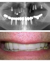Kombinacija mostova na implantatima i prirodnim zubima