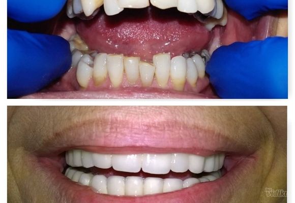 Gornja vilica uspešno rešena vađenjem parodontopatičnih zuba i postavkom 6 implantata i fiksnog mosta na njima, donja vilica rešena kombinacijom metalokeramičkog mosta na implantatima i prirodnim zubima, uz prethodno saniranje parodontopatije