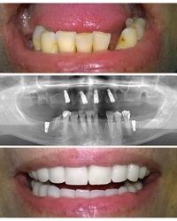Gornja bezuba vilica uspešno rešena protezom na implantatima, donja vilica kombinacijom metalokeramičkog mosta na prirodnim zubima i implantatima