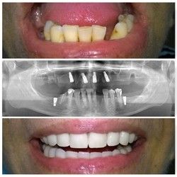 Gornja bezuba vilica uspešno rešena protezom na implantatima, donja vilica kombinacijom metalokeramičkog mosta na prirodnim zubima i implantatima