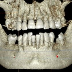 CBCT snimanje zuba 3Dent