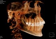 3D snimanje zuba