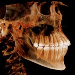 3D snimanje zuba