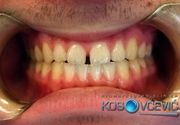 Beljenje zuba, Stomatoloska klinika Kosovcevic