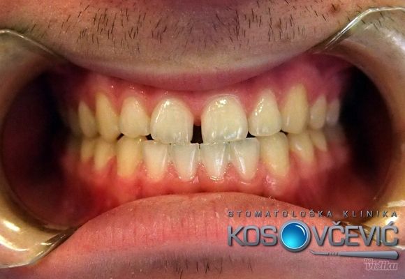 Beljenje zuba, Stomatoloska klinika Kosovcevic