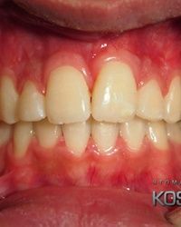 Stomatoloska klinika Kosovcevic, ortodoncija