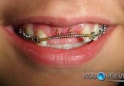 Stomatoloska klinika Kosovcevic, ortodoncija