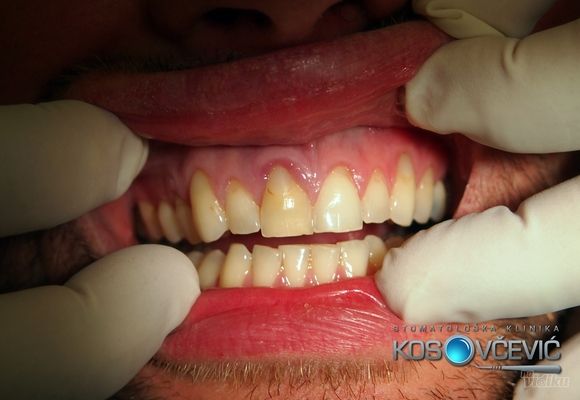 Zubni implanti, Stomatoloska klinika Kosovcevic