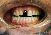 Zubni implanti, Stomatoloska klinika Kosovcevic