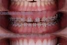 Ortodontska terapija