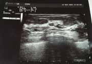 Ultrazvuk dojke i pazušnih jama