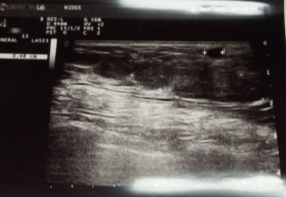 Ultrazvuk dojke i pazušnih jama