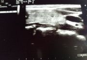 Ultrazvuk štitne žlezde i mekih tkiva vrata
