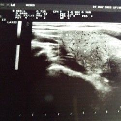 Ultrazvuk štitne žlezde i mekih tkiva vrata