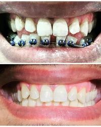 Pre i posle ortodontske i protetske terapije