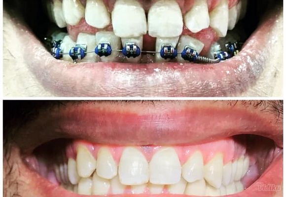 Pre i posle ortodontske i protetske terapije