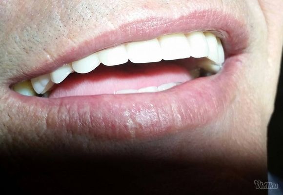 Parcijalna zubna proteza Pancevo