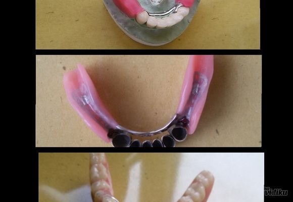 Wironit proteza zakačena atečmenima za metalokeramički most