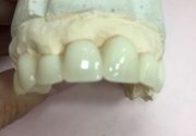 Privremeni plasticni zubi dok se ceka trajni fiksni rad