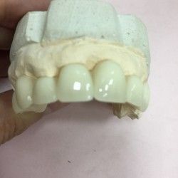 Privremeni plasticni zubi dok se ceka trajni fiksni rad