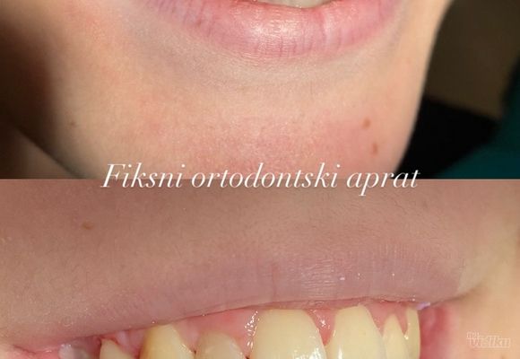fiksni-ortodontski-aparat-pancevo-ebb134.jpg