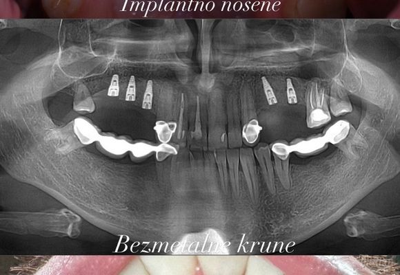 implantno-nosena-bezmetalna-krunica-8d0a7b.jpg