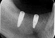 Ugradnja implanta zuba Pancevo