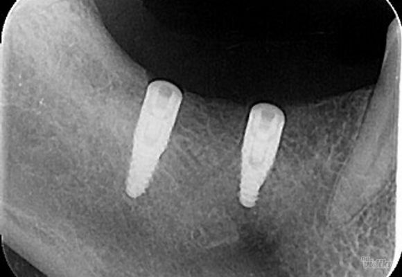 ugradnja-implanta-zuba-pancevo-943b06-1.jpg