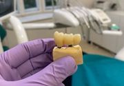 Ugradnja implanta zuba Pancevo