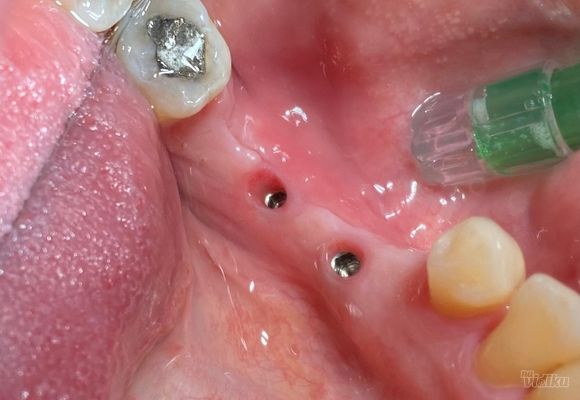 ugradnja-implanta-zuba-pancevo-943b06.jpg