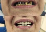 Zubni implanti Blok 70