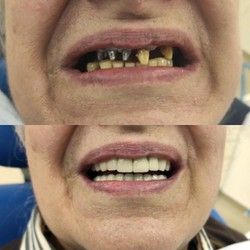 Zubni implanti Blok 70
