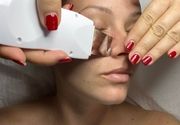 Ultrazvučno čišćenje lica Beograd