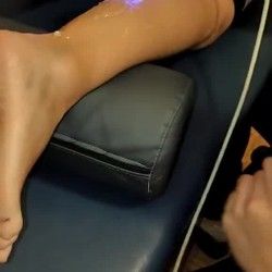 Shockwave terapija za misice nogu