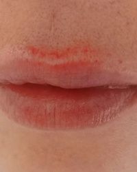 Hijaluronskim fileri, usne Kragujevac